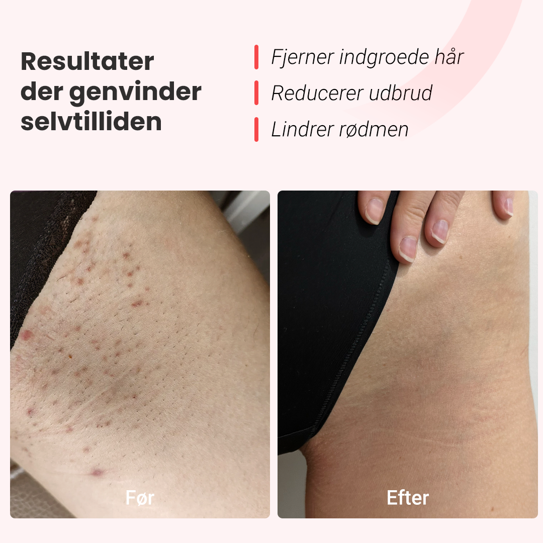 Hårfjerningssæt Hilda IPL Quartz